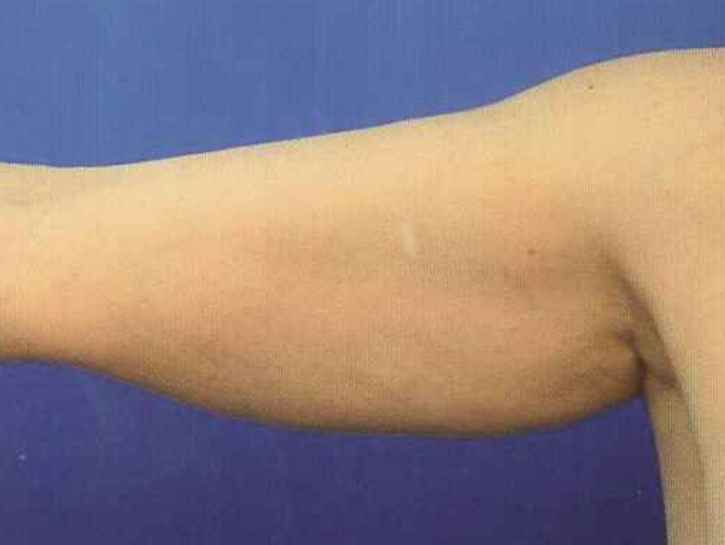 二の腕の脂肪分解
