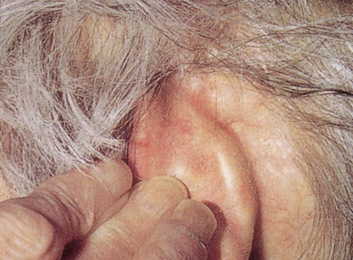 耳の傷跡