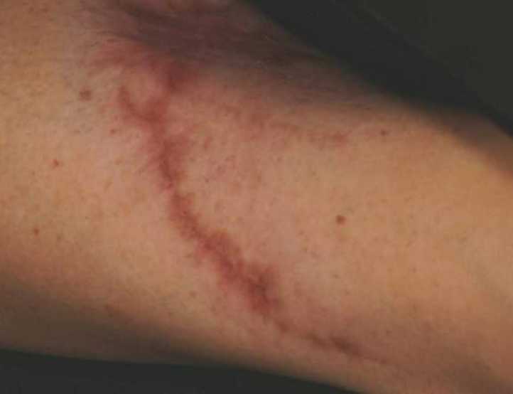 腕の傷跡