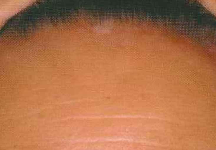 額の白斑